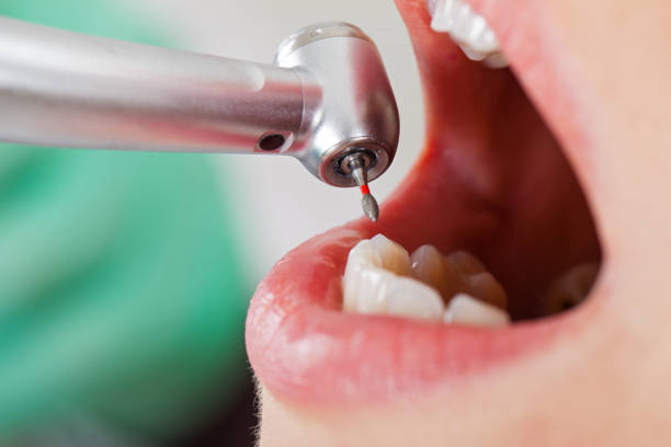 Best Emergency Care for Gum Disease in Ferndale, WA
